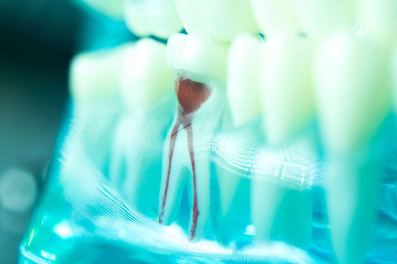 Traitement de canal - Endodontie Clinique dentaire KVO Clinique dentaire KVO à Ahuntsic